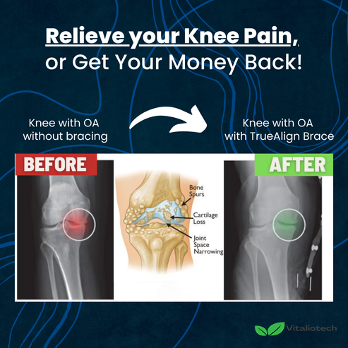 TrueAlign | Knee Brace + 3 FREE Gifts Today